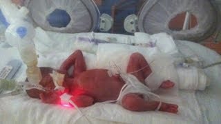 Born at 25 Weeks MicroPreemie Documentary [upl. by Mit330]