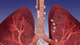 EBUS Procedure OverviewOlympus Bronchoscopy [upl. by Hsuk]