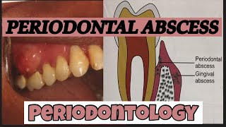 PERIODONTAL ABSCESS II PERIODONTOLOGY [upl. by Tallie]