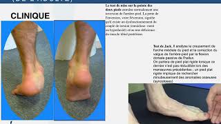 PIED PLAT VALGUS COURS P1 [upl. by Atews165]