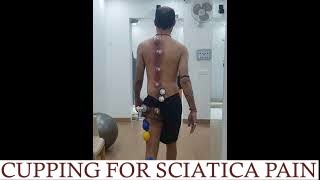 Cupping for Sciatica RELIEF [upl. by Anoyk214]