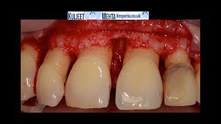 Periodontal Surgery Upper Front Teeth [upl. by Salema]