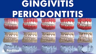 Gingivitis and Periodontitis  Evolution © [upl. by Chamberlin285]