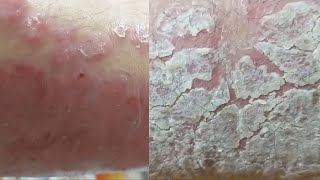 EXTREME REGENERATION 1 WEEK AFTER FULL CLEANING Psoriasis [upl. by Acul]