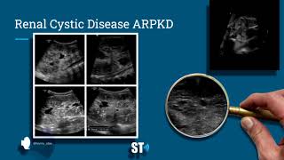 Renal Cysts Ultrasound [upl. by Talbot442]