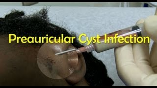 Preauricular Cyst Infection Management [upl. by Eatnuhs639]