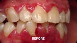 Treatment of Periodontal Gum Disease [upl. by Zsa718]