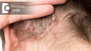 Treatment options for Scalp Psoriasis  Dr Rashmi Ravindra [upl. by Anomis202]