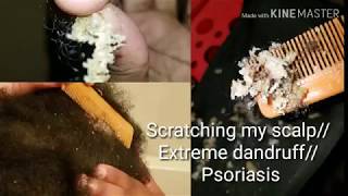 Scratching my scalp Extreme dandruff psoriasis [upl. by Ellis]