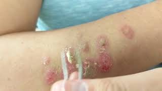 Petroleum Jelly  Tweezers vs Barnacles Psoriasis [upl. by Iahcedrom]