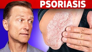 Psoriasis Treatment – The Best 3 Remedies for Psoriasis – DrBerg [upl. by Harlow268]