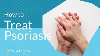 Psoriasis Treatment  Explained by Dermatologist [upl. by Aelak]