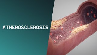 Atherosclerosis  Pathologies [upl. by Everson571]