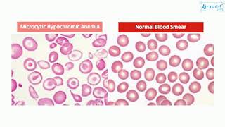 microcytic hypochromic anemia [upl. by Sylvia]