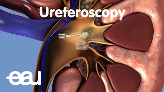 Kidney Stone Surgery amp Removal Procedures  Dr Brian D Hale [upl. by Florida744]