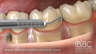 Periodontal disease causes and treatment [upl. by Sherlock607]