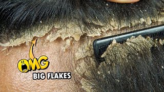 Psoriasis Scalp Scratching Huge Flakes 718 [upl. by Hallette]